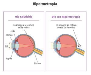 En Farmaoptics queremos explicaros mejor que es como corregir la hipermetropía y la miopía - Farmaoptics