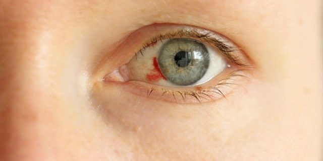 util-e-interesante-derrame-ocular-que-sale-sangre-ojo-n378478-640x360-593714
